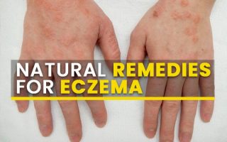 eczema