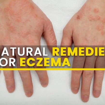 eczema