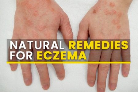 eczema