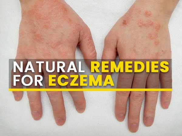 eczema