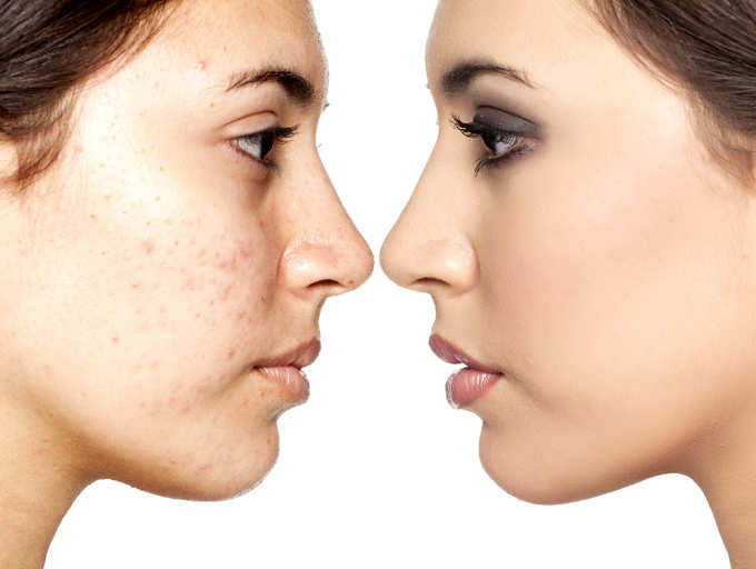 Hormonal acne