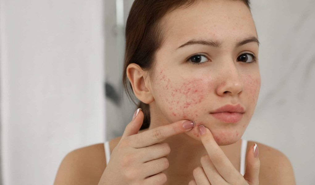 Acne Scars Treatment
