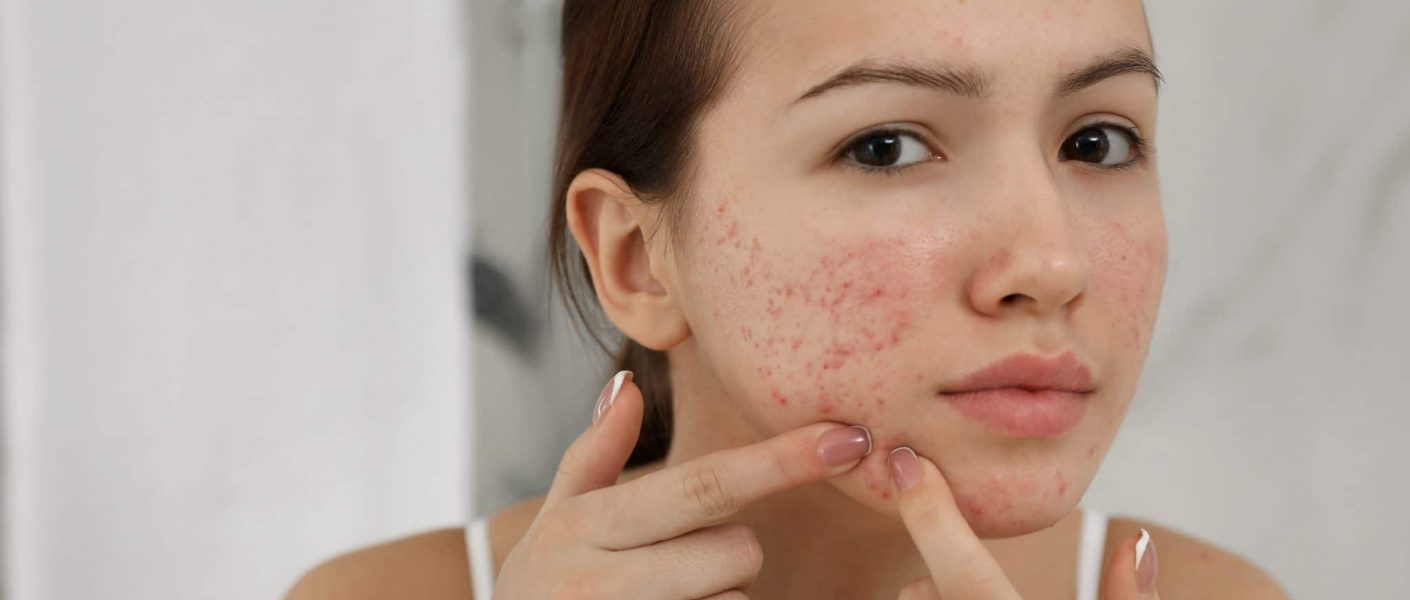 Acne Scars Treatment