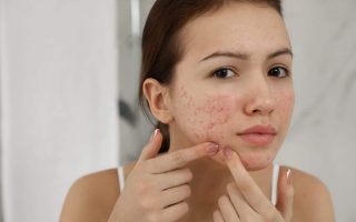 Acne Scars Treatment