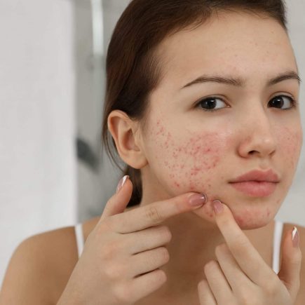 Acne Scars Treatment