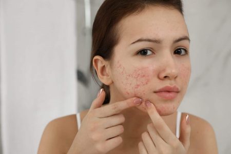 Acne Scars Treatment